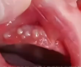 消毒险酿致命错！2个月宝宝被奶奶擦碘伏进ICU ！