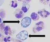 印度“食脑虫”感染病例数激增：主要通过口鼻腔等途径进入人体！