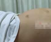 女大学生肚子大被搓澡阿姨救了一命 20厘米的大瘤子！