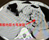 浙江一5岁女孩确诊长发公主综合征：胃里一大团头发 医生都懵了！