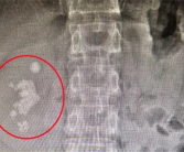 男子查出肾结石未重视拖成大麻烦：发展为铸型结石填满肾脏！