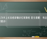 女孩以为手上长冻疮却确诊红斑狼疮 医生提醒：有这些症状要及时就诊！