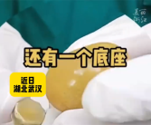 老人长期吃素胆囊长出金蛋状结石 医生：四类人群需注意!