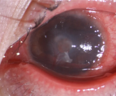 女子患流感5天不摘隐形眼镜近乎融化 医生：严重会造成永久性视力损伤 ！