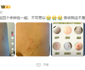 “蟑螂咬人”上热搜 《博物杂志》分析辟谣：三种可能!