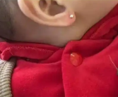 网友给8个月大的女儿穿耳洞 医生提醒：很容易诱发感染！